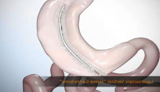 Laparoscopic Sleeve Gastrectomy